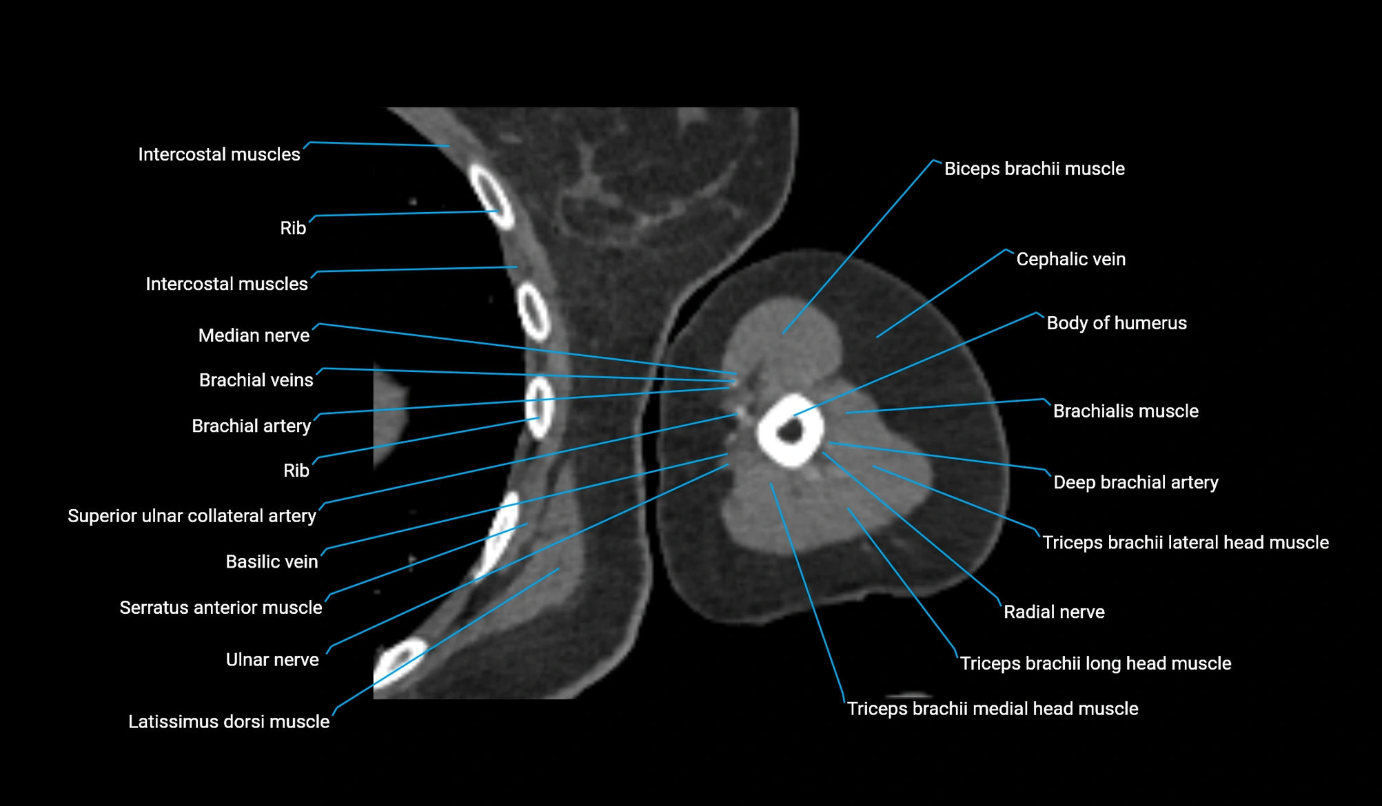 CT upper arm axial  cross sectional anatomy labelled radiology image -00248.webp